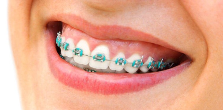 Брекеты на зубы для детей сколько стоят. Резинки для смещения зубов. Как ставят брекеты на зубы детям 12. Как ставят брекеты на зубы детям 12 лет.
